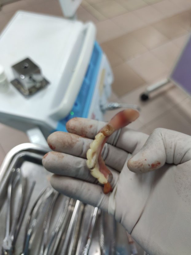 Dr Arif shares how his patient suffered from gum disease owing to fake dentures. Image credit: @ArepJawa
