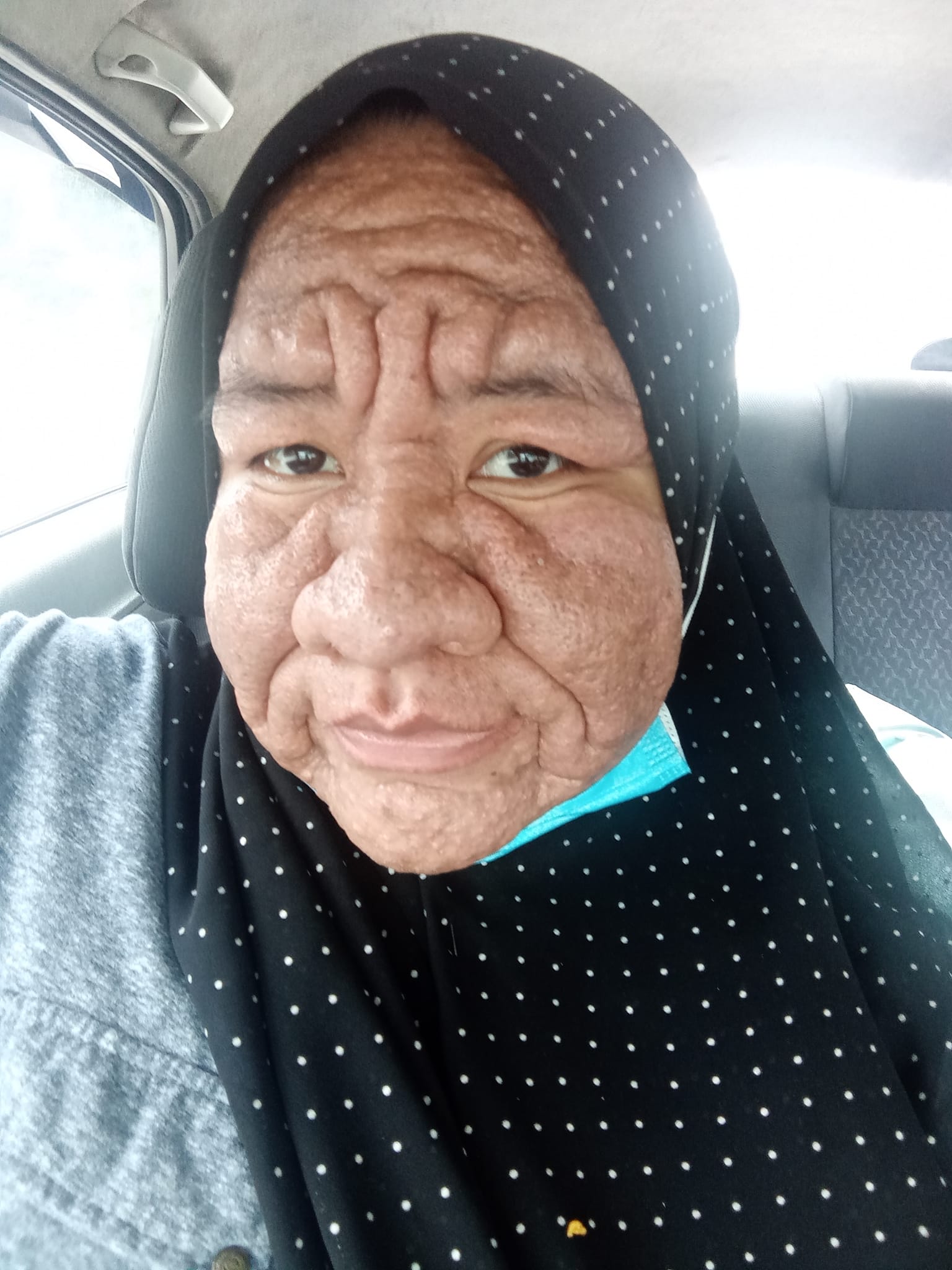 Nur Ain's skin appearing swollen and wrinkled during her pregnancy.