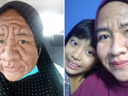 Cik Nur Ain showing the difference between her skin before and now.