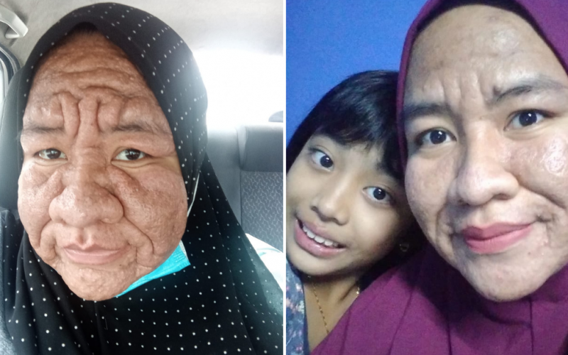 Cik Nur Ain showing the difference between her skin before and now.