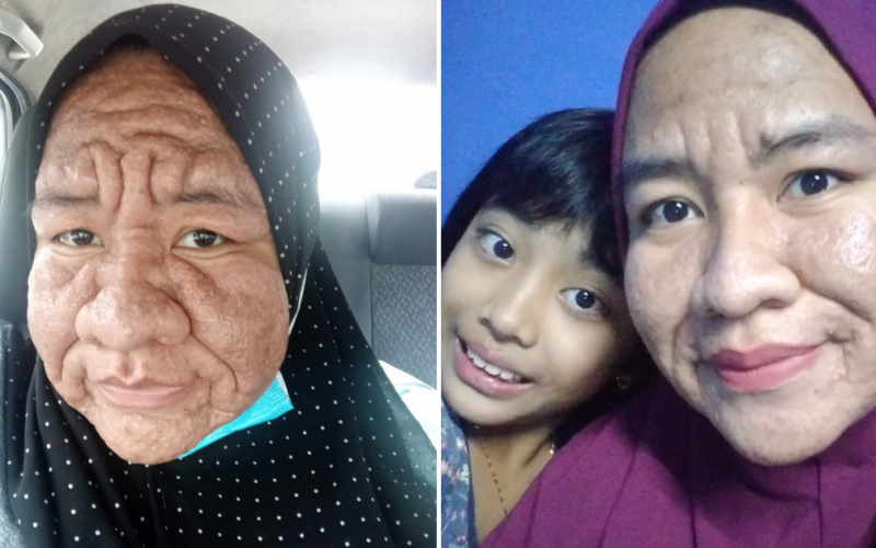 m-sian-woman-shares-how-her-face-became-swollen-heavily-wrinkled