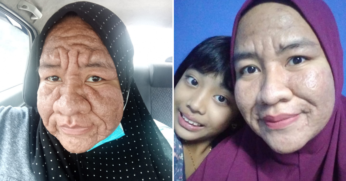 M'sian woman shares how her face became swollen & heavily wrinkled ...