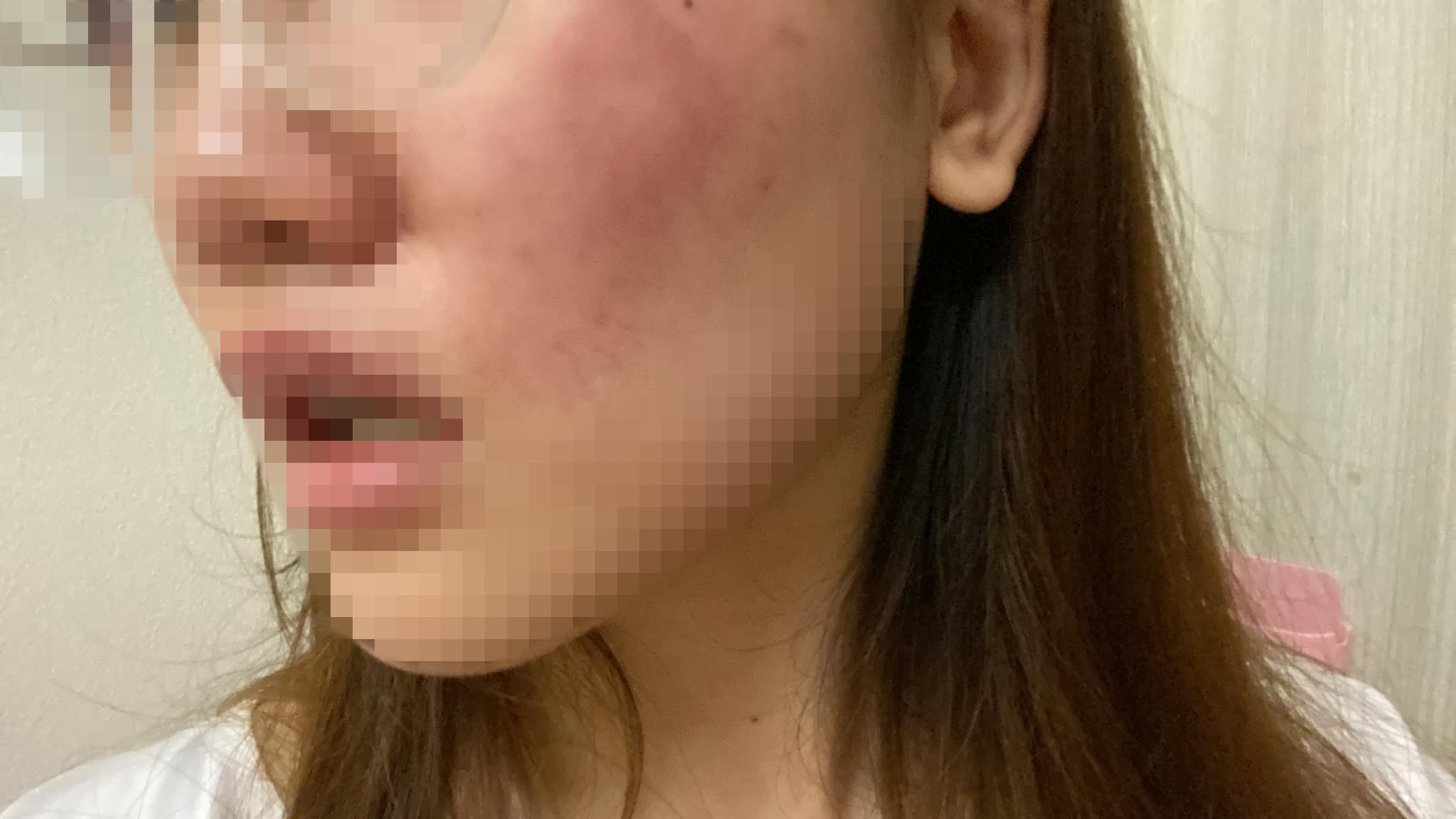 The slap left Vestene with a visible mark on her cheek. Source: Vestene Wong