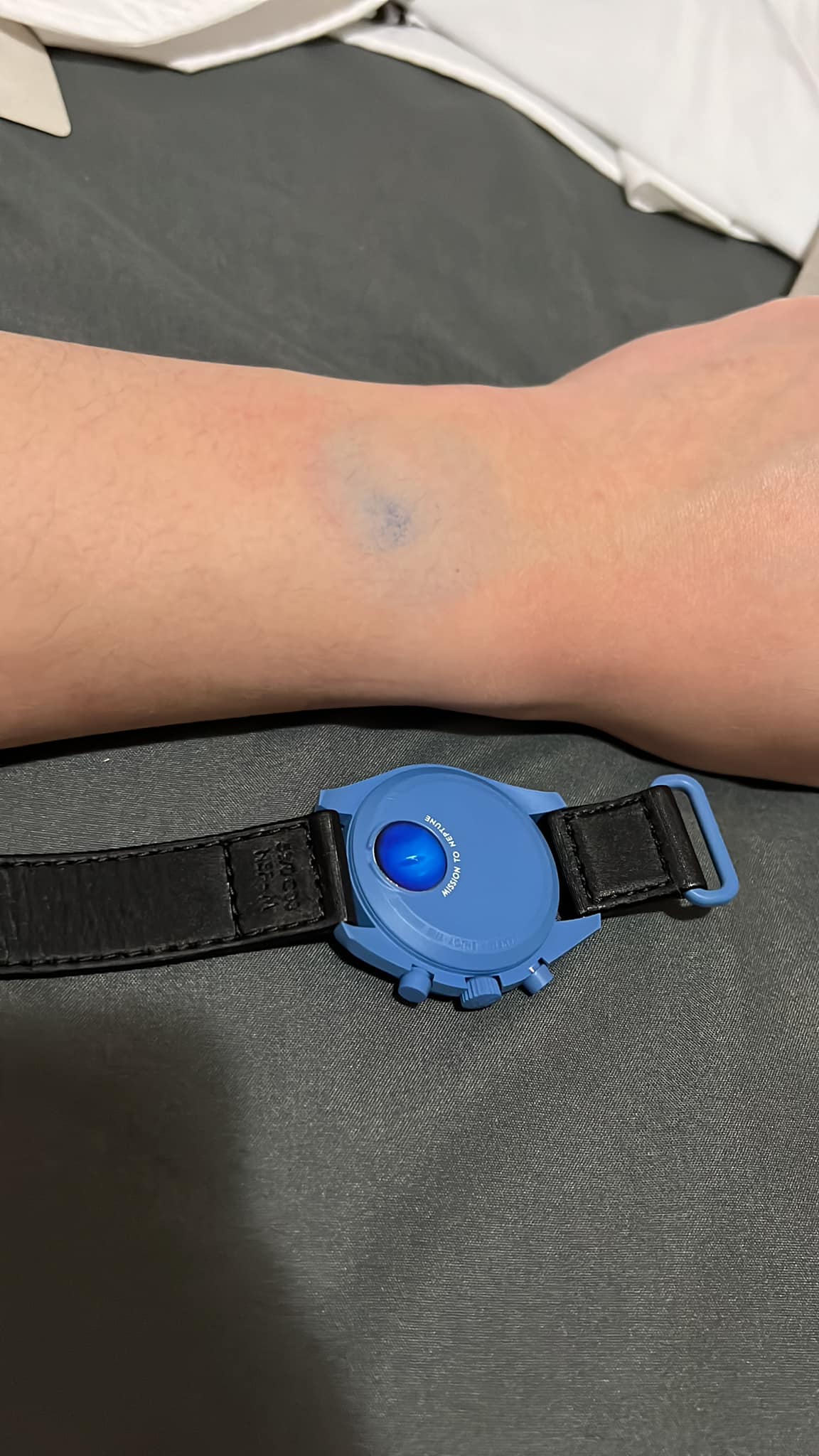 Jeffrey shows how the Swatch x OMEGA MoonSwatch watchcase had left dye transfer on his wrist. Source: Jeffrey So