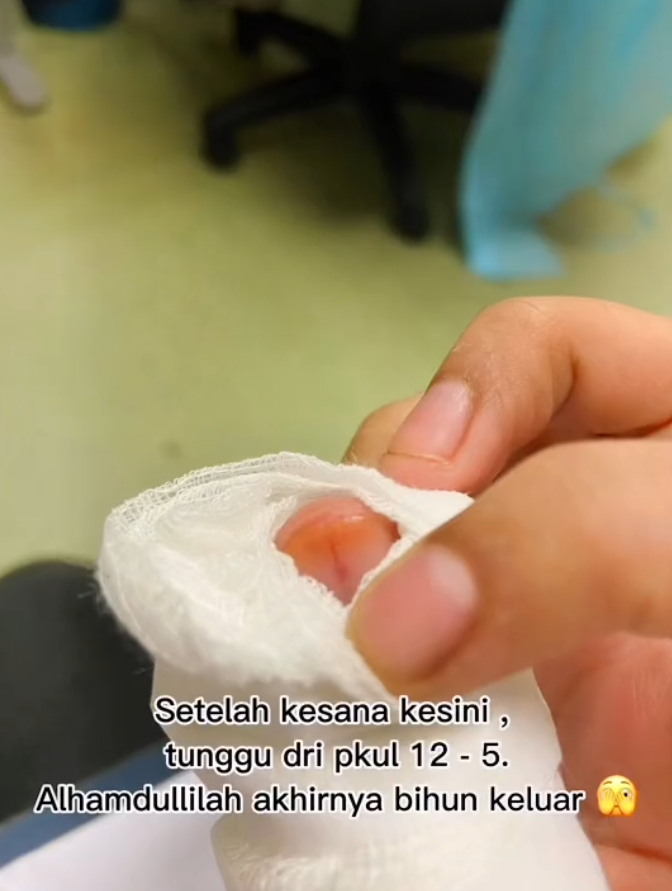 Shaa wound up visiting a hospital to have the piece of bihun extracted from underneath her nail. Source: sweetsecrettt21