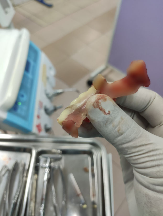 Dr Arif shares how his patient suffered from gum disease owing to fake dentures. Image credit: @ArepJawa