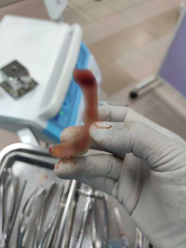 Dr Arif shares how his patient suffered from gum disease owing to fake dentures. Image credit: @ArepJawa