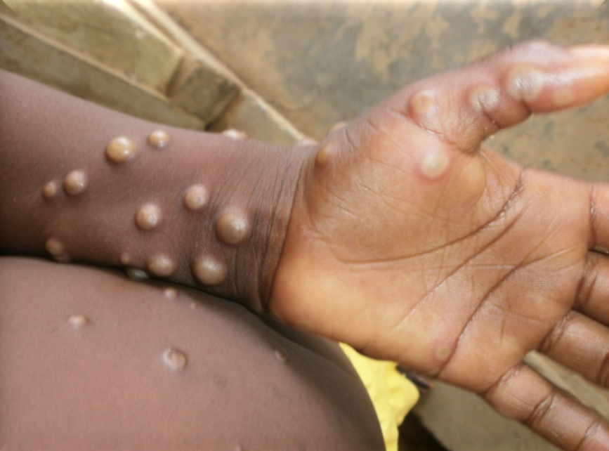 Monkeypox is typically characterised by rashes that also show signs of blisters. Image credit: WHO